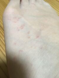 突然 手の指の側面と 足の甲に小さなボツボツができました これって水虫で Yahoo 知恵袋