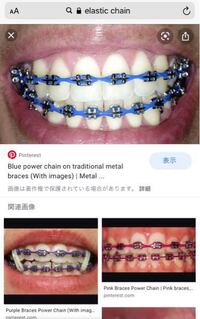 歯列矯正では 付けたいと言ったらこのようなカラフルなチェーンを付ける Yahoo 知恵袋