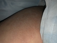 １ヶ月以上前から内ももが痒くて仕方ないです 湿疹のようなブツブツはあ Yahoo 知恵袋