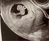 ラムジーメソッドわかりますか 8週5日のですなんとなくでお願いします 女 Yahoo 知恵袋