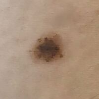 これはメラノーマでしょうか 太ももの黒子についてです 急にできたわけではなく1 Yahoo 知恵袋