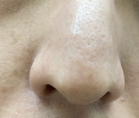 洗顔後の角栓はある程度とるべきでしょうか 画像は洗顔後 水で一度肌を Yahoo 知恵袋