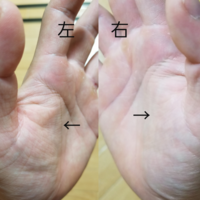 Alsを不安で何度も質問させてもらってるものです 一年前からぴくつきはあるもの Yahoo 知恵袋