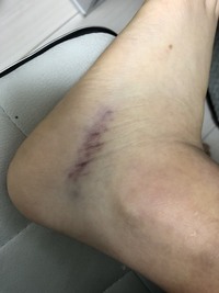 部活中に足首を思い切り捻挫して くるぶしら辺の腫れがひどく 直後や翌日は動くの Yahoo 知恵袋