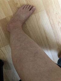 左足です 椅子に座ると足の色が変わり画像のようにマダラ模様になります Yahoo 知恵袋