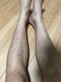 本当に嫌で我慢できません グロくて汚い脚をすみません 最近脚 Yahoo 知恵袋