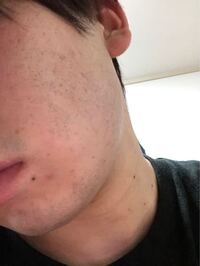 この通り肌も汚く髭も濃いです 色んな化粧水 乳液など他にも色々してるんで Yahoo 知恵袋