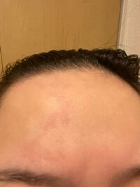 おでこに赤い痣 のようなものででてきました 痛みかゆみ等はあり Yahoo 知恵袋