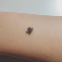 ほくろの除去を考えているのですが このような直径が約10mmある大き Yahoo 知恵袋