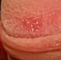 これは亀頭の一部分です これは梅毒ですか 痒みはないです 痛く Yahoo 知恵袋