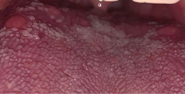 舌の奥にぶつぶつが出来ているのですがこれは何ですか？