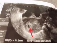 妊娠妊娠初期5w1dの会社員です 本日病院に行ってきました 先生はま Yahoo 知恵袋