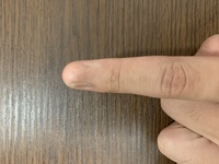 私の左手の人差し指のことについて教えてください これは生まれつきです 他の Yahoo 知恵袋