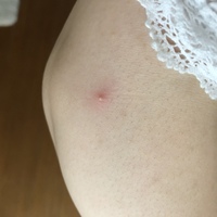 腕に吹き出物のようなものが出来ました 触ると痛いです ニキビのように白いものが Yahoo 知恵袋