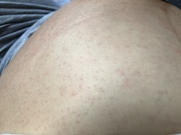 妊娠後期9ヶ月の妊婦です 今朝痒くて身体を見たところ写真のようなブツブツが出来 Yahoo 知恵袋