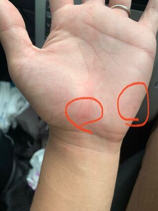 手のひら に 白い ぶつぶつ