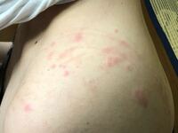 昨晩背中に痒みがあり 気がつくと左右に痒みを感じるので 見てみると Yahoo 知恵袋