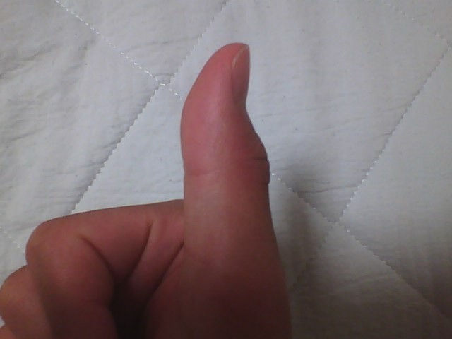 内出血 突き指 今日のバスケの試合で突き指っぽいのをしてしまいました なので冷 Yahoo 知恵袋