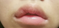 口周り汚くてごめんなさい 唇が腫れています 上唇の左側が腫れているの Yahoo 知恵袋