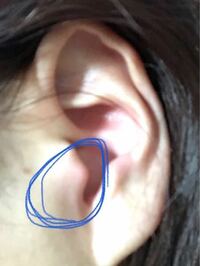耳のこの部分が腫れていて 触ると痛いのですが 考えられる原因が考えられる Yahoo 知恵袋