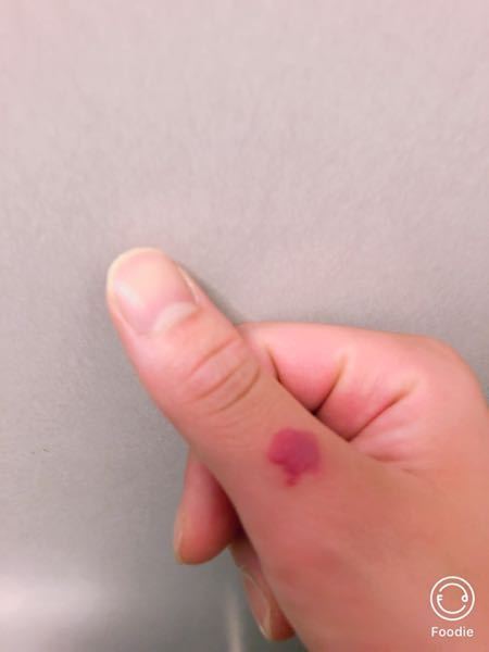 水虫 解決済みの質問 Yahoo 知恵袋