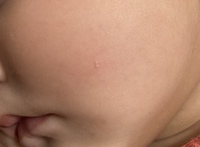 赤ちゃんのお肌にできたこの白い斑点 はなんでしょうか ニキビ ほっといても Yahoo 知恵袋