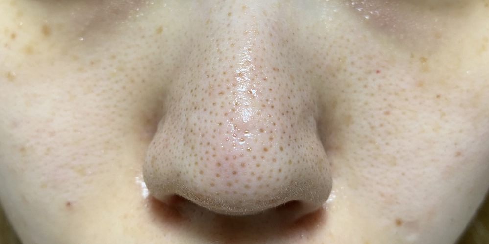 気性 福祉 スラック ダーマペン 黒ずみ Everrite Jp