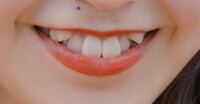 八重歯ある子ってどう思う うち八重歯あるけどいまいち好きになれないんだよねーき Yahoo 知恵袋