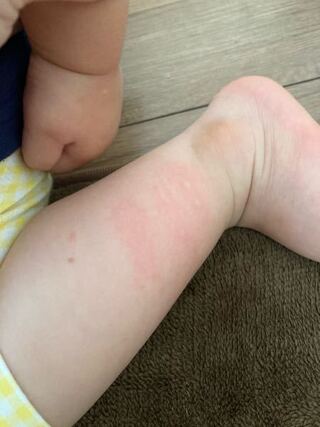 一歳8ヶ月の子供です 子供が足が痛いと言っているので見ると何かに刺さ Yahoo 知恵袋
