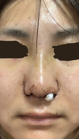 鼻の整形のダウンタイムについて教えてください 23日に鼻の手術をしました 手術 Yahoo 知恵袋