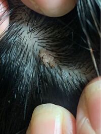 閲覧注意です 頭皮にこのような出来物ができています なぜでしょ Yahoo 知恵袋