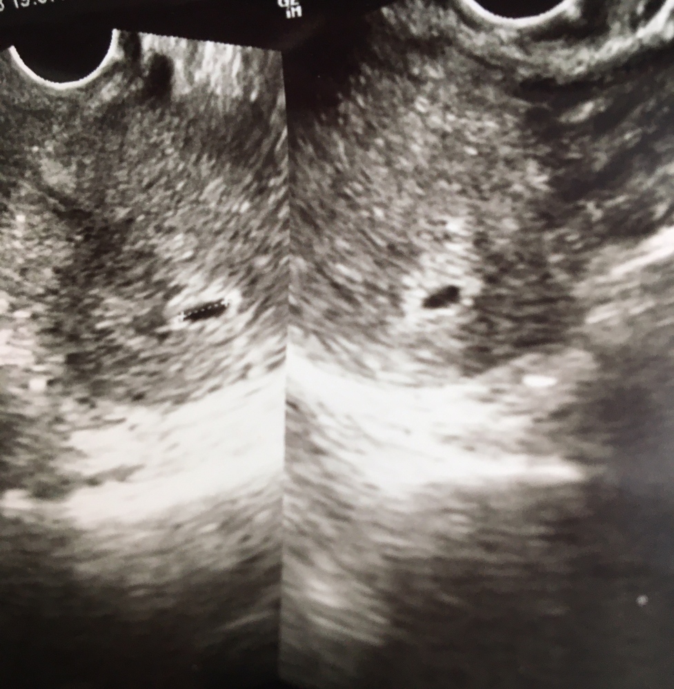 妊娠6週0日で卵黄嚢 胎芽が見えないのは異常でしょうか 恥ずか Yahoo 知恵袋