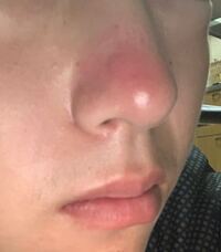 汚い画像ですみませんm M鼻のボコボコと赤みについて 夏頃から鼻が Yahoo 知恵袋