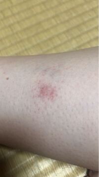 このような内出血 が足に2 3個できています 何か気をつけた方が良いものでしょ Yahoo 知恵袋