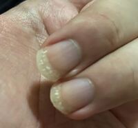 皮膚や爪の症状について詳しい方にお伺いします 最近 伸びた爪の先 Yahoo 知恵袋