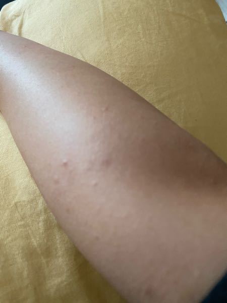 皮膚の病気 アトピー 解決済みの質問 Yahoo 知恵袋