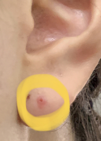 どうしましょう ピアスが入らなくなってしまいました 昨年９月下旬に皮膚科 Yahoo 知恵袋