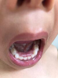 子どもの歯がこんな風に生えてきてます 乳歯は抜ける気配がありません Yahoo 知恵袋