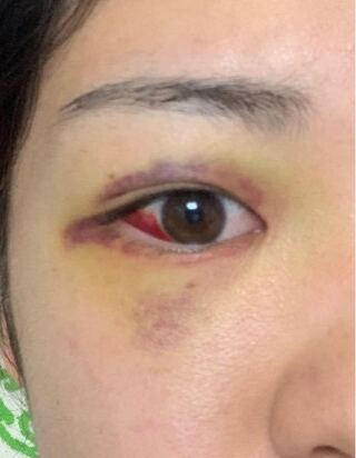 8 13の朝 ベットの角で顔面を強打してしまい 目の周りに内出血を起 Yahoo 知恵袋