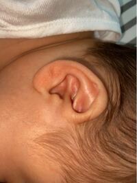 赤ちゃんの耳からウミの様な液体が出ます 生後１ヶ月半の赤ちゃんですが 耳たぶに Yahoo 知恵袋
