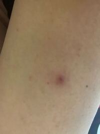 真ん中にかさぶたがあるような かゆみもない赤い湿疹 のようなもの Yahoo 知恵袋