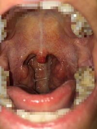 お見苦しい写真すみません 三日くらい前から 物を飲み込むと喉が痛 Yahoo 知恵袋