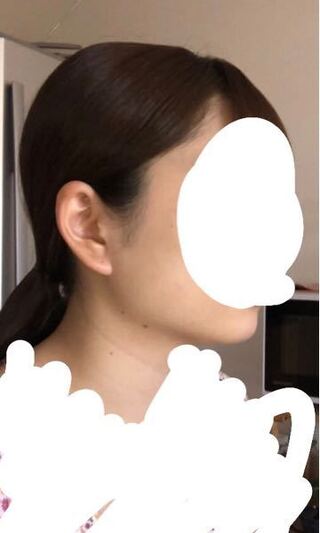 エラ張りがコンプレックスなのですが 見た感じ筋肉ですか 骨格ですか Yahoo 知恵袋