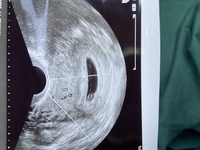 卵黄嚢しか見えませんでした 皆さまいつ胎芽や心拍確認できましたでしょ Yahoo 知恵袋