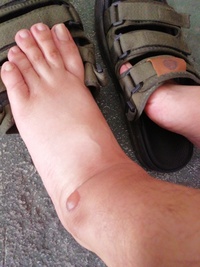朝起きると足首に水ぶくれみたいな物が出来ていました 病気でしょうか Yahoo 知恵袋