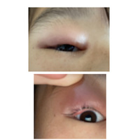 目が腫れて痛いです画像のようになってます 閲覧注意 これって何ですか 眼科 Yahoo 知恵袋