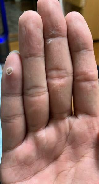 だいぶ前から手の小指に魚の目 タコ みたいのがあるのですがこれってそうですかね Yahoo 知恵袋