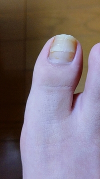 足の親指の爪が横に割れました 出血していません 剥がれてもいません 形成外科に Yahoo 知恵袋