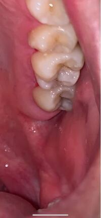 虫歯についてです 汚い写真で申し訳ないですが 奥歯がこのように灰色 Yahoo 知恵袋