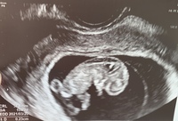 妊娠9週6日でntがみつかりました 2 3mmでした 次の受診で大き Yahoo 知恵袋